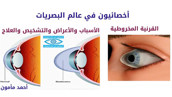 Eye illustration showing keratoconus condition with diagnostic and treatment icons.
