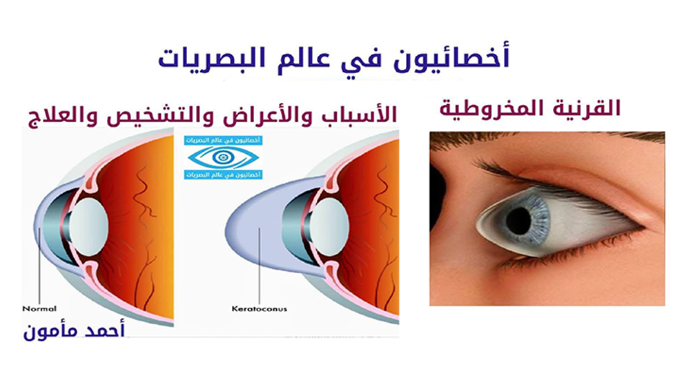 Eye illustration showing keratoconus condition with diagnostic and treatment icons.